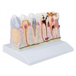 Dentalmodell, 4-fache Größe