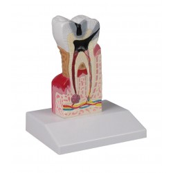 Erler-Zimmer Zahnkariesmodell, 10-fache Größe